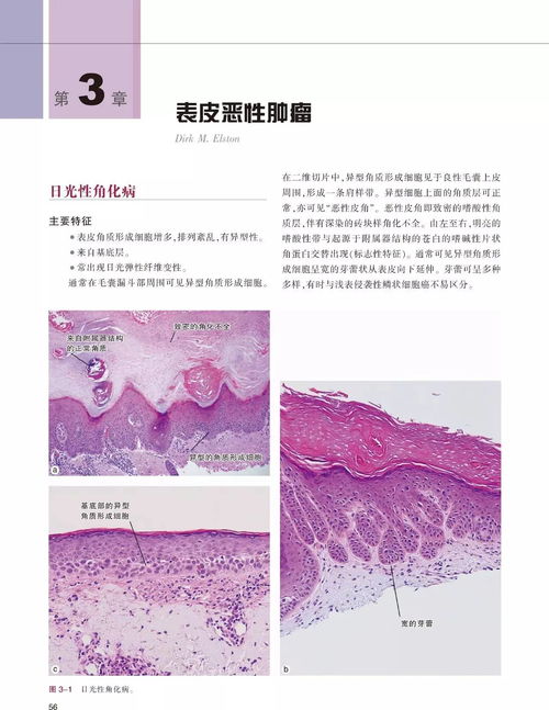 T细胞淋巴瘤-皮肤红斑结节当湿疹，皮肤科医生让做病理