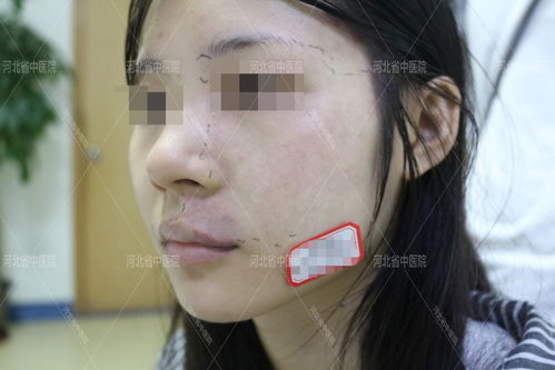 T细胞淋巴瘤-皮肤红斑结节当湿疹，皮肤科医生让做病理