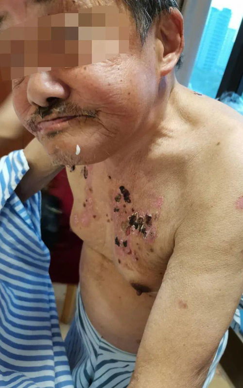 细胞,淋巴瘤,皮肤,红斑,结节