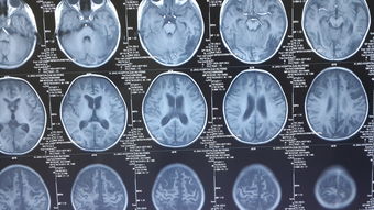 室管膜瘤-第四脑室占位，梗阻性脑积水