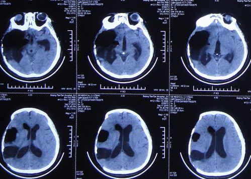 室管膜瘤-第四脑室占位，梗阻性脑积水