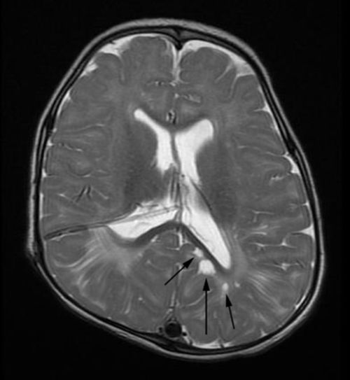 室管,膜瘤,第四,脑室,占位