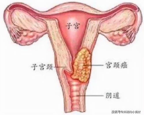 宫颈癌,术后,三年,复查,正常