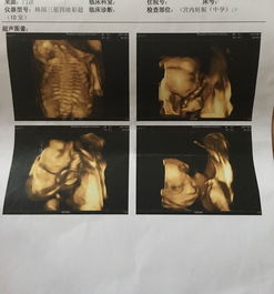 宫颈癌-宫颈癌术后三年复查正常，妇科医生说可以试着要孩子