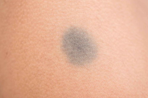 黑色素瘤-脚底黑痣越长越大，足外科医生看了一眼让马上切除