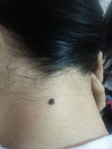 黑色素瘤-脚底黑痣越长越大，足外科医生看了一眼让马上切除