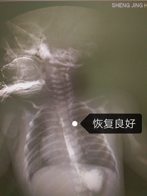 食管癌-吞咽梗阻感半年，胃镜发现食管全周狭窄