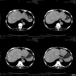 腹水-肚子越来越大以为是长胖，消化科医生叩诊发现移动性浊音
