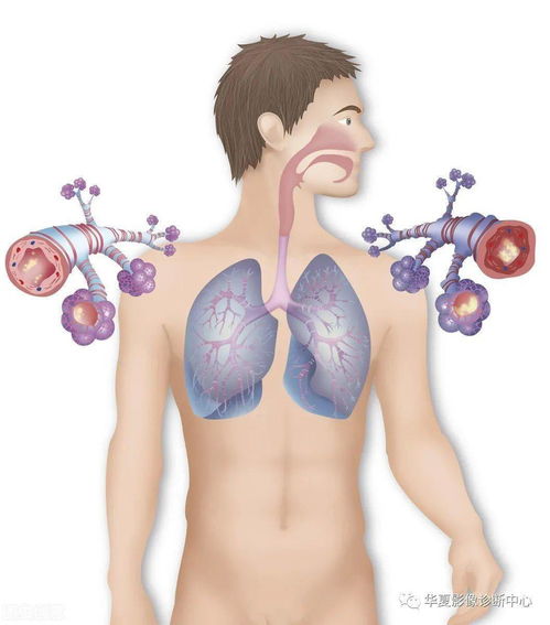 骨转移癌-肺癌术后两年腰疼，以为腰肌劳损，骨扫描发现多处骨转移