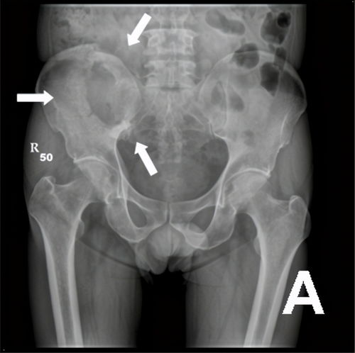 骨转移癌-肺癌术后两年腰疼，以为腰肌劳损，骨扫描发现多处骨转移