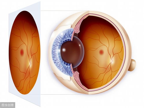 视网膜母细胞瘤-儿童白瞳症，眼底检查发现