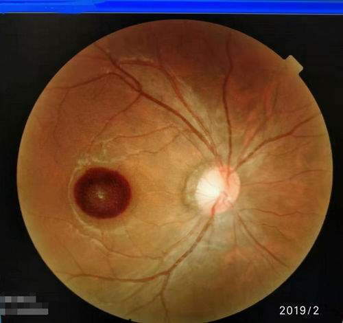 视网膜母细胞瘤-儿童白瞳症，眼底检查发现