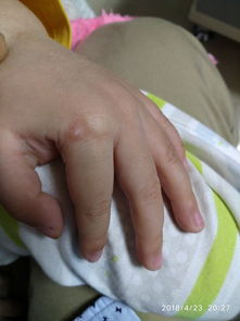 蕈样肉芽肿-皮肤瘙痒多年治不好,皮肤科医生说可能是早期淋巴瘤 蕈样肉芽肿-皮肤瘙痒多年治不好,皮肤科医生说可能是早期淋巴瘤