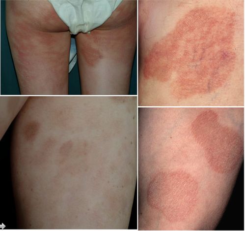 蕈样肉芽肿-皮肤瘙痒多年治不好,皮肤科医生说可能是早期淋巴瘤 蕈样肉芽肿-皮肤瘙痒多年治不好,皮肤科医生说可能是早期淋巴瘤