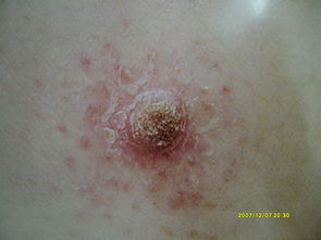 蕈样肉芽肿-皮肤瘙痒多年治不好,皮肤科医生说可能是早期淋巴瘤 蕈样肉芽肿-皮肤瘙痒多年治不好,皮肤科医生说可能是早期淋巴瘤