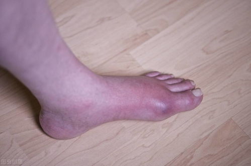 骨痛-全身骨痛当风湿治两年，骨科医生让查血发现多发瘤