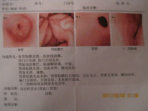 食管癌-吃东西总觉得噎得慌，做了胃镜没事，半年后确诊食管癌