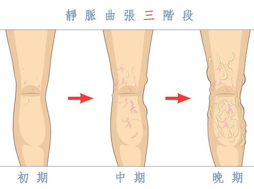 腿痛-腿痛当关节炎治了半年，血管外科查出下肢动脉闭塞