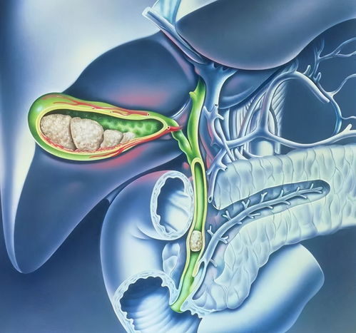腹痛-上腹痛当胃病治了三年，肝胆外科查出胆总管结石