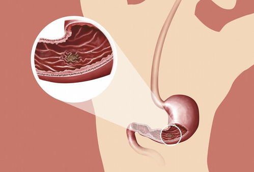 腹痛-上腹痛当胃病治了三年，肝胆外科查出胆总管结石