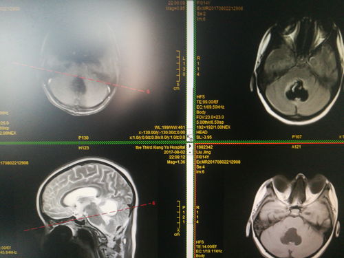 脑胶质瘤-视力下降看眼科没问题，神经外科医生让查视野发现颅内占位