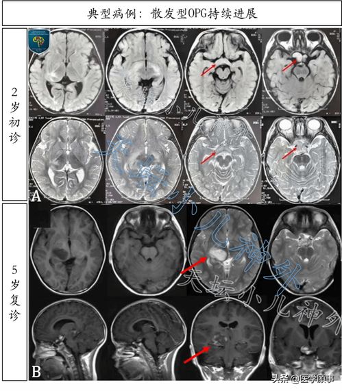 脑胶质瘤-视力下降看眼科没问题，神经外科医生让查视野发现颅内占位