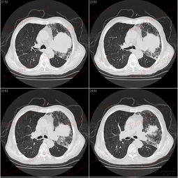 胸痛-胸痛当心绞痛治了半年，做了一次胃镜发现是反流性食管炎