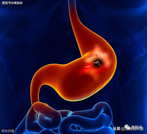 胃溃疡-胃溃疡反复发作，最后切胃的病人，术前问了医生一句话