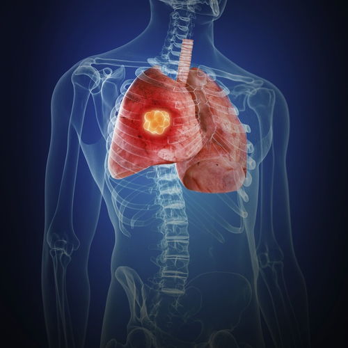 肺癌-体检胸片正常，一年后咳血查出肺癌，影像科医生说胸片有盲区