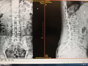 腰痛-腰痛当腰椎间盘突出治了一年，血管外科查出腹主动脉瘤