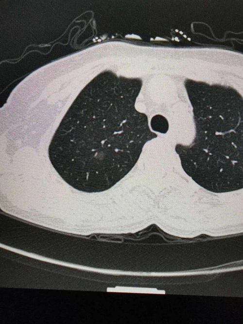 肺癌-那个每年体检都拍胸片的老人,最后还是查出晚期肺癌 肺癌-那个每年体检都拍胸片的老人,最后还是查出晚期肺癌