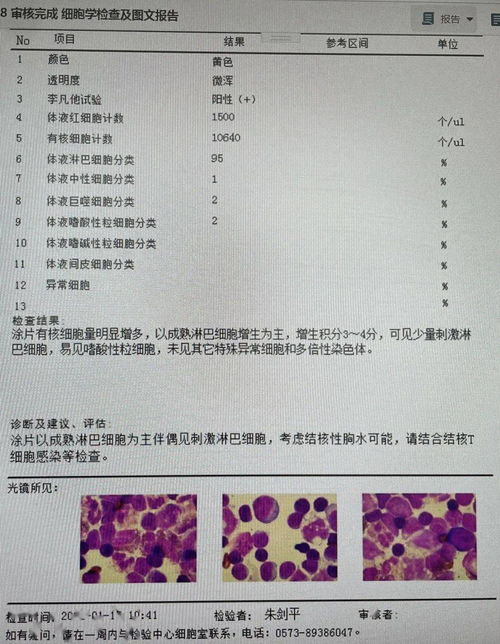 胸膜间皮瘤-石棉接触史胸水查不出原因，胸外科胸腔镜活检确诊