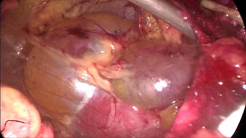 肾嫌色细胞癌-体检发现肾占位，手术预后良好