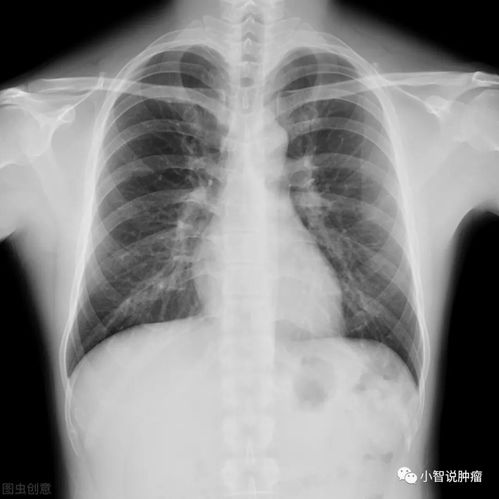 肺癌-咳血丝痰去拍胸片没发现问题，半年后确诊肺癌，呼吸科医生说胸片有盲区