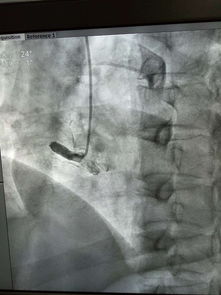 肺癌-咳血丝痰去拍胸片没发现问题，半年后确诊肺癌，呼吸科医生说胸片有盲区