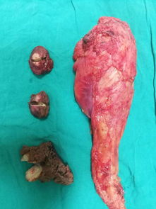 肝转移癌-肠癌术后三年肝上发现占位，肝胆外科评估后二次手术切除