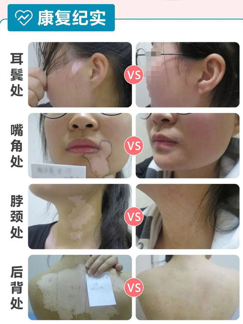 308激光：准分子激光治白癜风