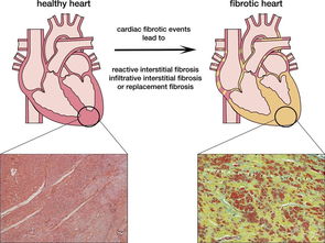 CAR-T：改造T细胞打肿瘤，血液瘤效果好