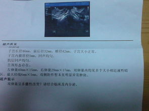 PCOS：多囊卵巢综合征的英文缩写，备孕女性的坎