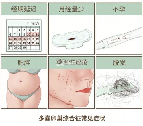 PCOS：多囊卵巢综合征的英文缩写，备孕女性的坎