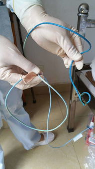 ERCP：十二指肠镜下给胆管取石头、放支架