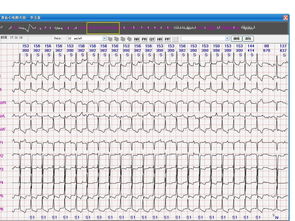 24小时动态心电图：背了一天心电图，报告怎么看？一文教会你