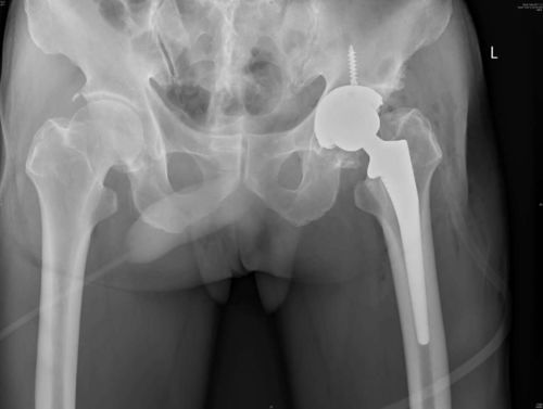 DDH,关节,发育不良