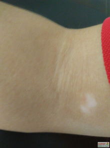 UVB光疗：照紫外线治银屑病