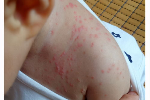 丹毒：腿上红肿热痛，细菌感染了