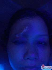 伍德,照灯,真菌,白癜风