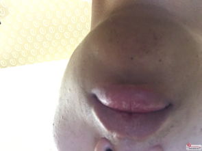 伍德灯：照灯查真菌白癜风