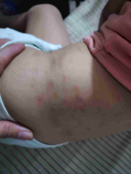 体表肿物：身上长东西