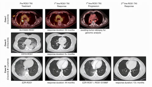 克唑替尼和色瑞替尼哪个治肺癌好