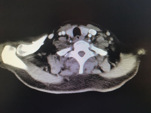 吉西他滨治疗癌效果怎么样